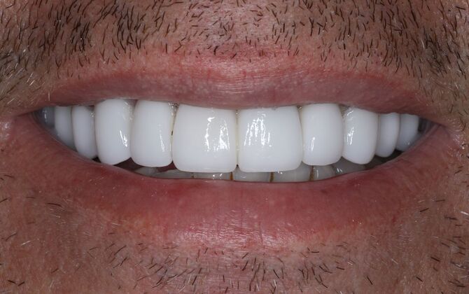 Veneers Case 28 - After