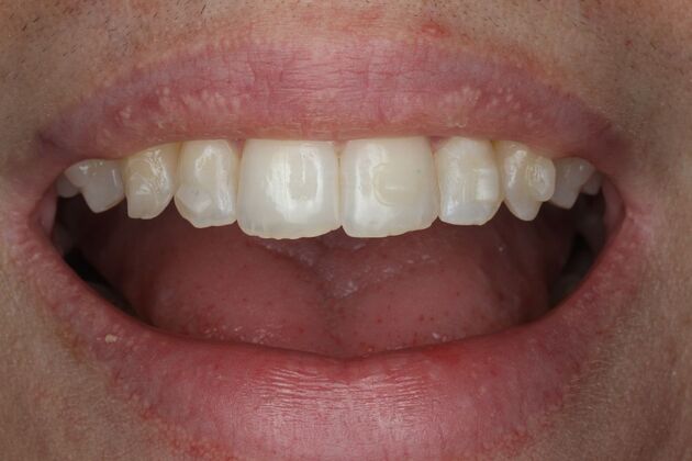 Veneers Case 29 - Before