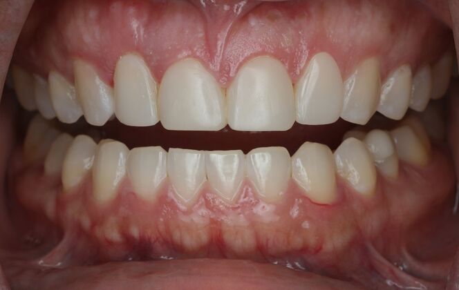 Veneers Case 30 - After