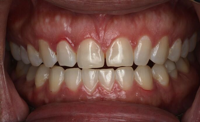 Veneers Case 30 - Before