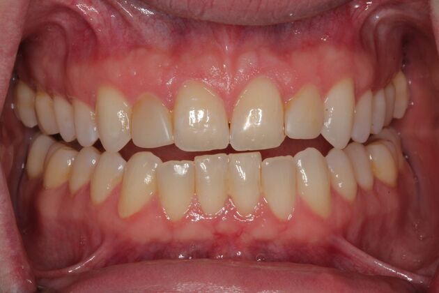 Veneers Case 31 - Before