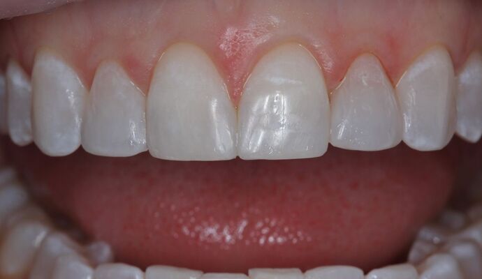 Veneers Case 32 - After