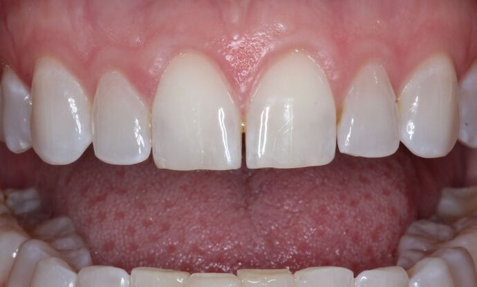 Veneers Case 32 - Before
