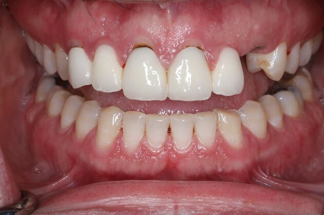 Veneers Case 33 - Before
