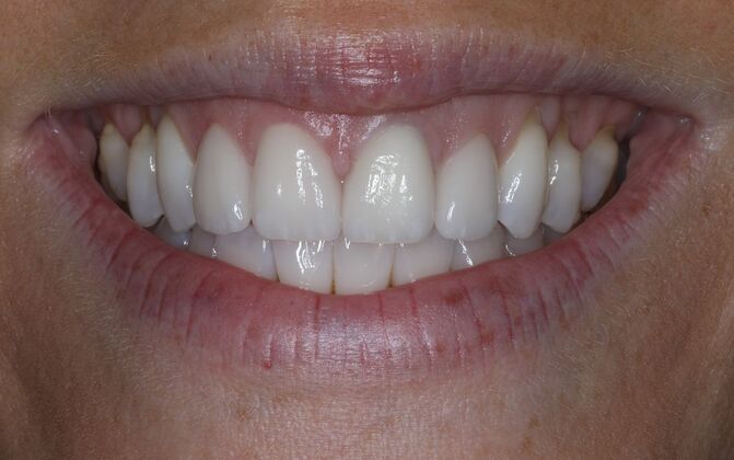 Veneers Case 34 - After