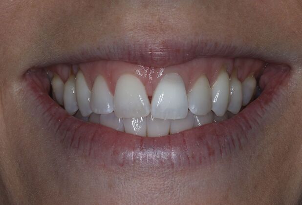 Veneers Case 34 - Before