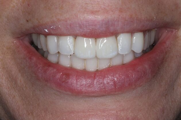 Veneers Case 35 - After
