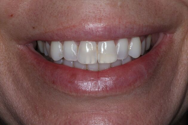 Veneers Case 35 - Before