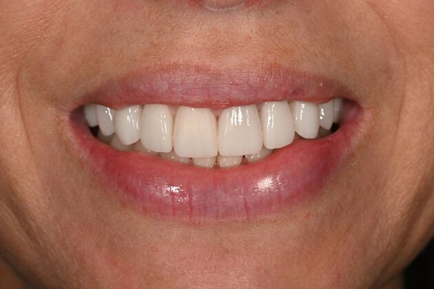 Veneers Case 36 - After