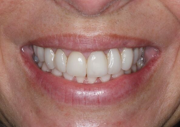 Veneers Case 36 - Before