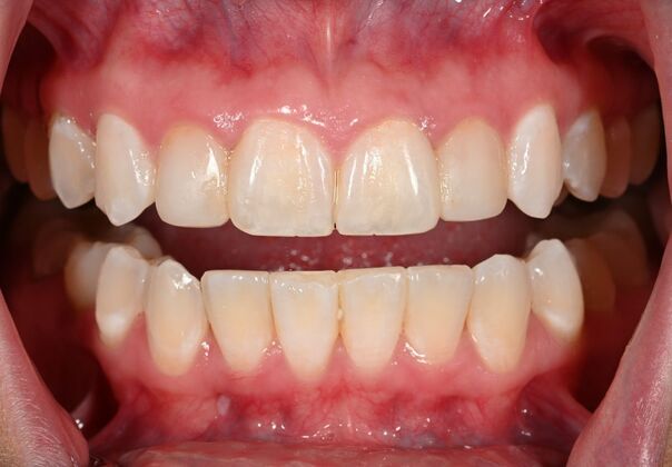 Veneers Case 37 - After