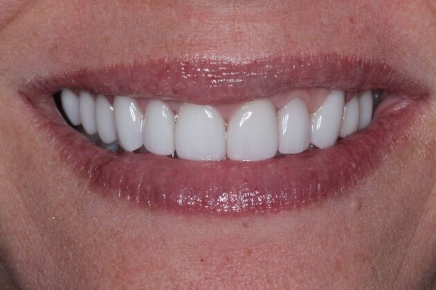 Veneers Case 38 - After