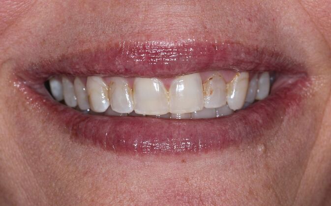 Veneers Case 38 - Before