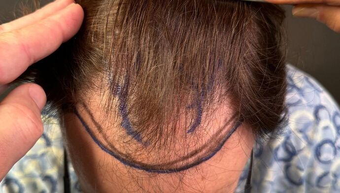 FUT Hair Restoration: Case 49 - Before