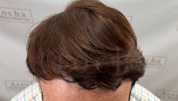 FUT Hair Restoration: Case 49 - After