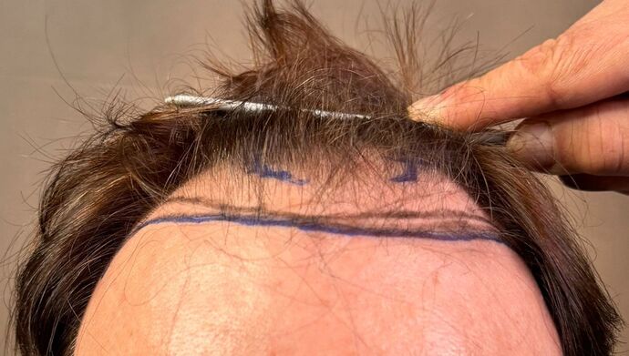 FUT Hair Restoration: Case 49 - Before