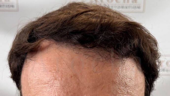 FUT Hair Restoration: Case 49 - After