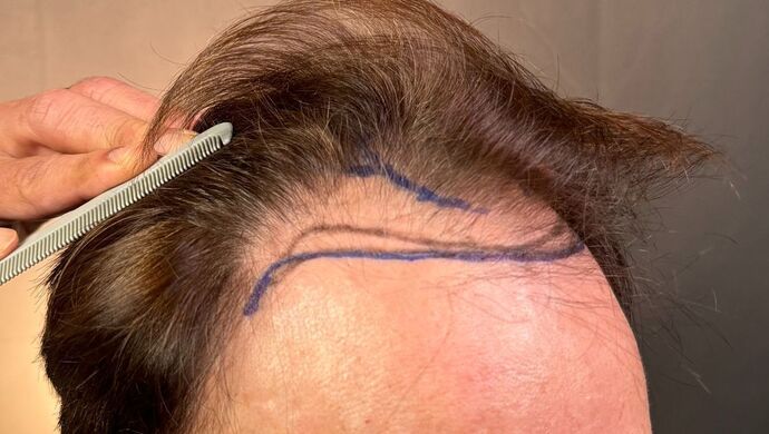 FUT Hair Restoration: Case 49 - Before