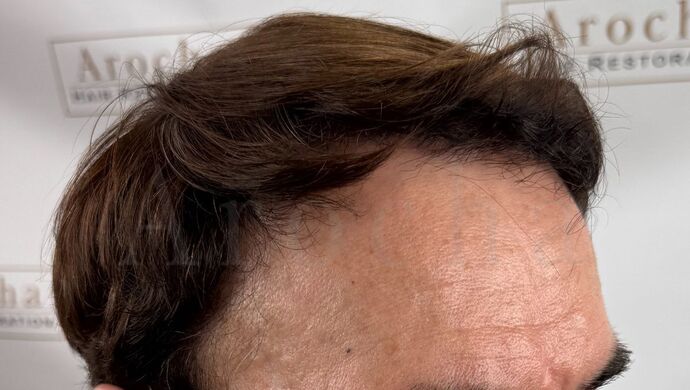 FUT Hair Restoration: Case 49 - After