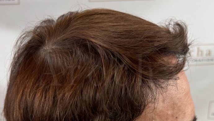 FUT Hair Restoration: Case 49 - After