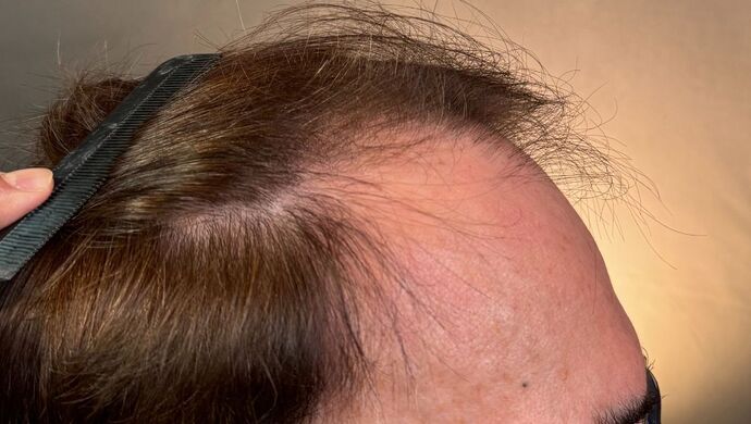 FUT Hair Restoration: Case 49 - Before