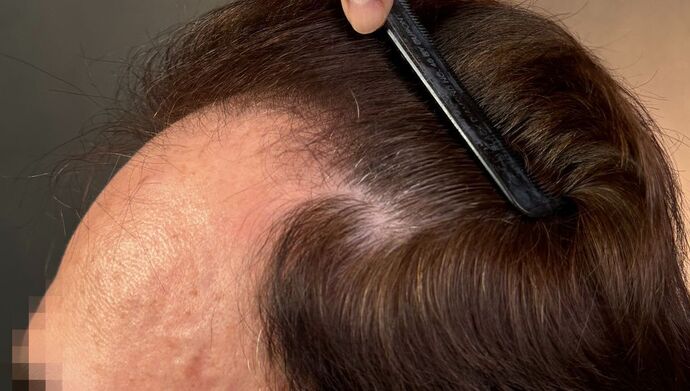 FUT Hair Restoration: Case 49 - Before