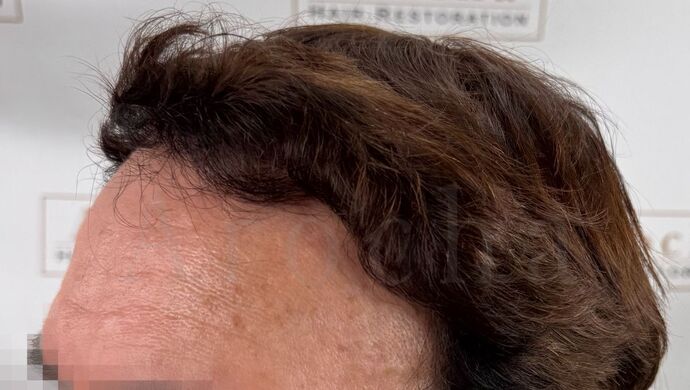 FUT Hair Restoration: Case 49 - After
