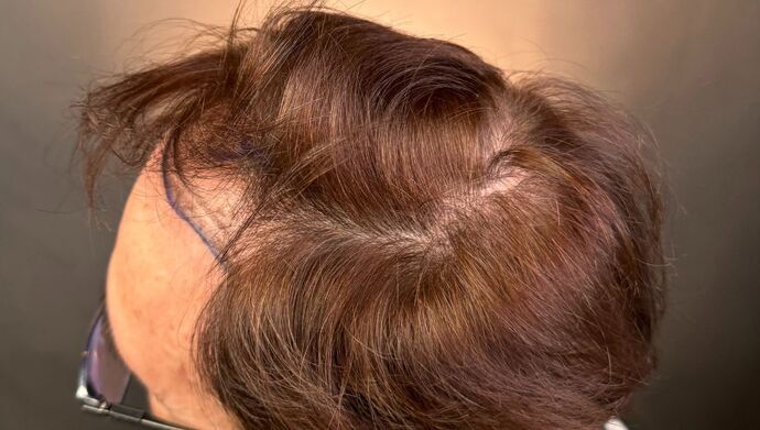 FUT Hair Restoration: Case 49 - Before