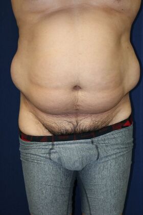 LIPOSUCTION 360*: Case 3 - Before