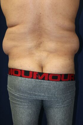 LIPOSUCTION 360*: Case 3 - Before