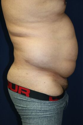 LIPOSUCTION 360*: Case 3 - Before
