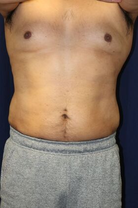 LIPOSUCTION 360*: Case 3 - After