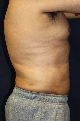 LIPOSUCTION 360*: Case 3 - After