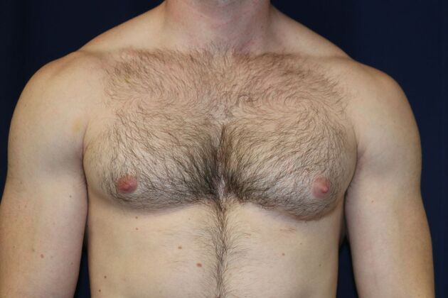 Male Breast Reduction* Case 10 - Before