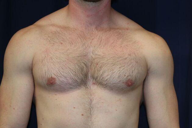 Male Breast Reduction* Case 10 - After