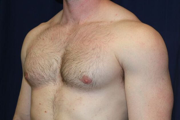Male Breast Reduction*: Case 10 - After