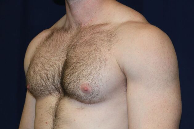 Male Breast Reduction*: Case 10 - Before