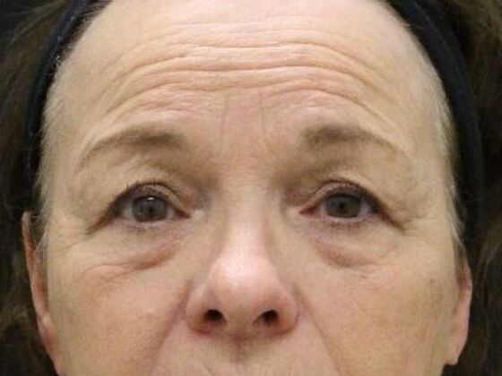 Eyelid Surgery Case 17 - Before