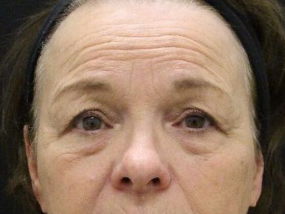 Forehead & Brow Lifts Case 4 - Before