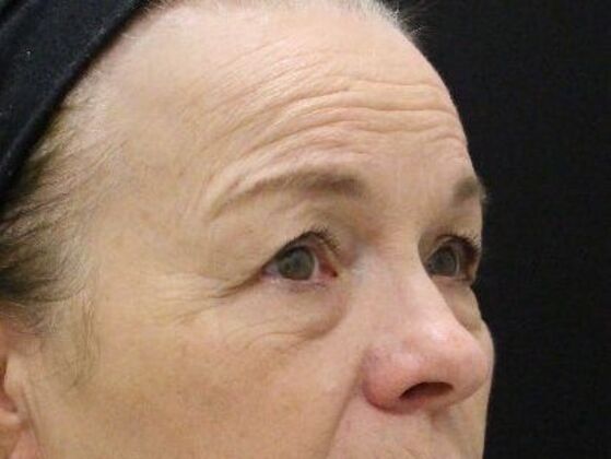 Forehead & Brow Lifts: Case 4 - Before