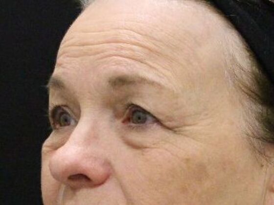 Forehead & Brow Lifts: Case 4 - Before