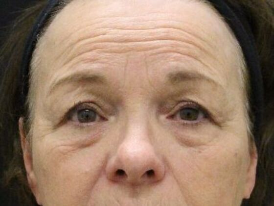 Non-Surgical: Case 12 - Before