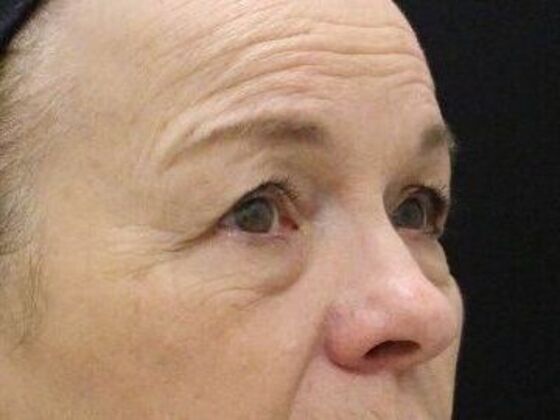 Non-Surgical: Case 12 - Before