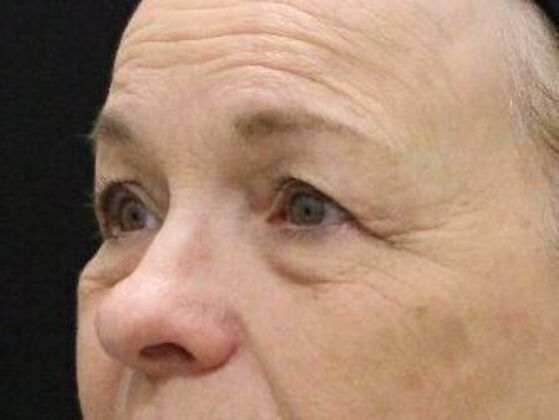 Non-Surgical: Case 12 - Before