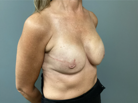 Breast Reconstruction: Case 1 - After (2nd Surgery, 3 Month Post-Op)