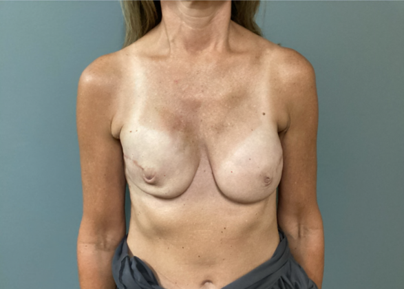 Breast Reconstruction: Case 1 - After (1st Surgery, 3 Month Post-Op)