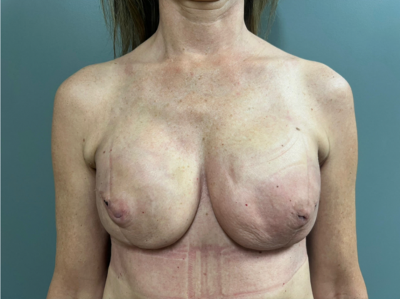 Breast Reconstruction: Case 1 - After (1st Surgery, 1 month Post-Op)