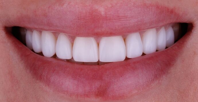 Smile Design Cases Case 12 - After