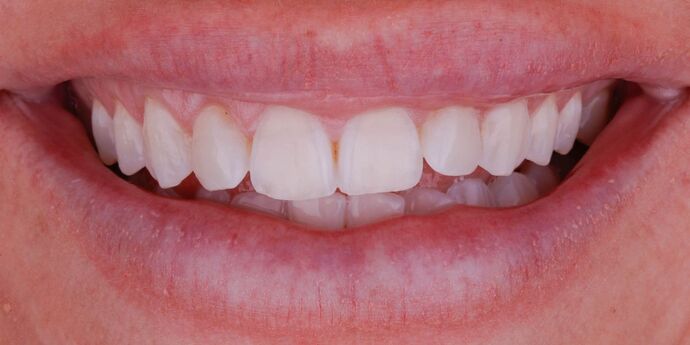 Smile Design Cases Case 1 - Before