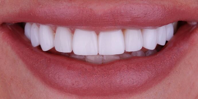 Smile Design Cases Case 1 - After